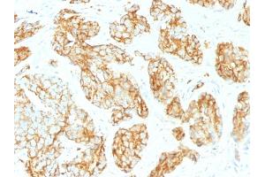 Formalin-fixed, paraffin-embedded human Prostate Carcinoma stained with CD44 Mouse Monoclonal Antibody (CD44v9/1459). (CD44 antibody)