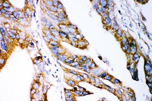 Anti- Claudin 2 antibody, IHC(P) IHC(P): Human Intestinal Cancer Tissue (Claudin 2 antibody  (AA 38-230))