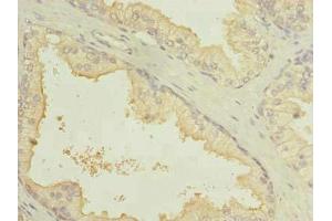 Immunohistochemistry of paraffin-embedded human prostate cancer using ABIN7164401 at dilution of 1:100 (SLC7A14 antibody  (AA 676-771))