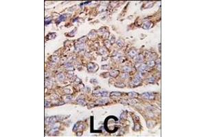 Formalin-fixed and paraffin-embedded human lung carcinoma tissue reacted with *LP1 antibody (N-term) (ABIN388566 and ABIN2849737) , which was peroxidase-conjugated to the secondary antibody, followed by DAB staining. (LAMP1 antibody  (N-Term))