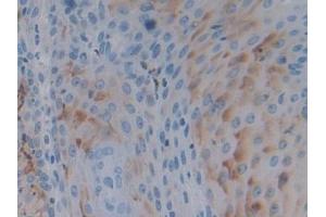 Detection of PTPRH in Human Skin cancer Tissue using Polyclonal Antibody to Protein Tyrosine Phosphatase Receptor Type H (PTPRH) (PTPRH antibody  (AA 844-1096))