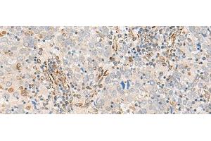Immunohistochemistry of paraffin-embedded Human cervical cancer tissue using FECH Polyclonal Antibody at dilution of 1:55(x200) (FECH antibody)