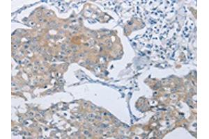 The image on the left is immunohistochemistry of paraffin-embedded Human breast cancer tissue using ABIN7189583(ABCB9 Antibody) at dilution 1/15, on the right is treated with synthetic peptide. (ABCB9 antibody)