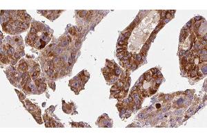 ABIN6277215 at 1/100 staining Human liver cancer tissue by IHC-P. (P2RY6 antibody  (C-Term))
