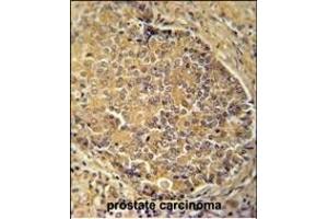 IGSF1 antibody (C-term) (ABIN654689 and ABIN2844381) immunohistochemistry analysis in formalin fixed and paraffin embedded human prostate carcinoma followed by peroxidase conjugation of the secondary antibody and DAB staining. (IGSF1 antibody  (C-Term))
