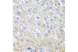 Immunohistochemistry of paraffin-embedded human liver cancer using COX1/COX1/PTGS1 antibody (ABIN6130124, ABIN6146413, ABIN6146414 and ABIN6223187) at dilution of 1:100 (40x lens). (PTGS1 antibody  (AA 1-180))