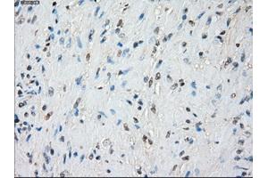 Immunohistochemical staining of paraffin-embedded Adenocarcinoma of colon tissue using anti-BUB1Bmouse monoclonal antibody. (BUB1B antibody)