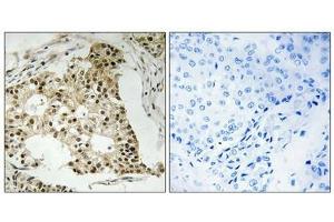 Immunohistochemistry analysis of paraffin-embedded human breast carcinoma tissue using Retinoic Acid Receptor α (Phospho-Ser77) antibody. (Retinoic Acid Receptor alpha antibody  (pSer77))