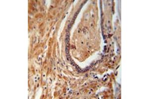 Immunohistochemistry analysis in formalin fixed and paraffin embedded human prostate carcinoma reacted with NDUFAF1 Antibody (C-term) followed which was peroxidase conjugated to the secondary antibody and followed by DAB staining. (NDUFAF1 antibody  (C-Term))