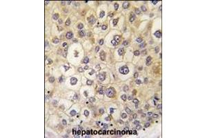 Formalin-fixed and paraffin-embedded human hepatocarcinoma tissue reacted with ARHE antibody (Center) (ABIN392162 and ABIN2841881) , which was peroxidase-conjugated to the secondary antibody, followed by DAB staining. (RND3 antibody  (AA 133-165))