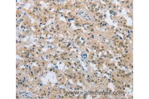 Immunohistochemistry of Human thyroid cancer using ENTPD5 Polyclonal Antibody at dilution of 1:20 (ENTPD5 antibody)