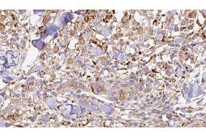 ABIN6276952 at 1/100 staining Human Melanoma tissue by IHC-P. (CNTF antibody  (C-Term))