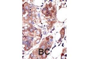 Formalin-fixed and paraffin-embedded human cancer tissue reacted with the primary antibody, which was peroxidase-conjugated to the secondary antibody, followed by AEC staining. (MUSK antibody  (C-Term))