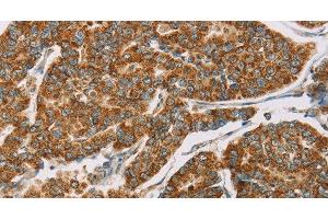 Immunohistochemistry of paraffin-embedded Human breast cancer tissue using DLL4 Polyclonal Antibody at dilution 1:40 (DLL4 antibody)