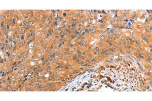 Immunohistochemistry of paraffin-embedded Human cervical cancer tissue using ACOX3 Polyclonal Antibody at dilution 1:35 (ACOX3 antibody)