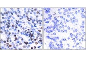 Immunohistochemistry analysis of paraffin-embedded human breast carcinoma tissue, using JunB (Ab-259) Antibody. (JunB antibody  (AA 226-275))