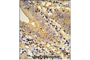 Formalin-fixed and raffin-embedded human colon carcinoma reacted with TSN33 Antibody (C-term), which was peroxidase-conjugated to the secondary antibody, followed by DAB staining. (TSPAN33 antibody  (C-Term))