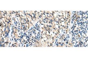 Immunohistochemistry of paraffin-embedded Human lung cancer tissue using DHRSX Polyclonal Antibody at dilution of 1:30(x200)