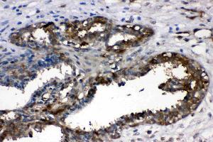 LDHA was detected in paraffin-embedded sections of human mammary cancer tissues using rabbit anti- LDHA Antigen Affinity purified polyclonal antibody (Catalog # ) at 1 µg/mL. (Lactate Dehydrogenase A antibody  (AA 2-106))