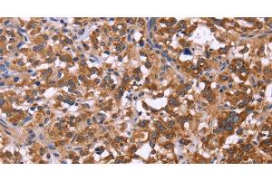 Immunohistochemistry of paraffin-embedded Human thyroid cancer tissue using FBXW7 Polyclonal Antibody at dilution 1:40 (FBXW7 antibody)
