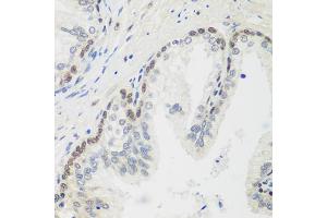 Immunohistochemistry of paraffin-embedded human prostate using MDC1 antibody (ABIN5974564) at dilution of 1/100 (40x lens). (MDC1 antibody)