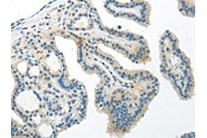 The image on the left is immunohistochemistry of paraffin-embedded Human thyroid cancer tissue using ABIN7193059(WNT10A Antibody) at dilution 1/30, on the right is treated with synthetic peptide. (Protein Wnt-1 (WNT1.L) antibody)