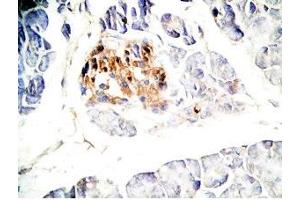 Human pancreas cancer tissue was stained by Rabbit Anti-GLP-1(7-36) -NH2 Antibody (GLP-1 antibody  (amidated))