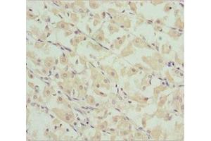 Immunohistochemistry of paraffin-embedded human gastric cancer using ABIN7149046 at dilution of 1:100 (CHIC2 antibody  (AA 1-165))
