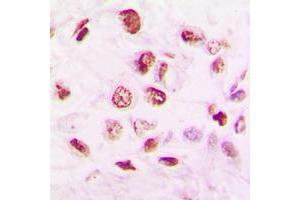 Immunohistochemical analysis of Histone Deacetylase 9 staining in human lung cancer formalin fixed paraffin embedded tissue section. (HDAC9 antibody  (C-Term))