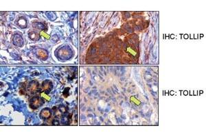 Middle panels, TOLLIP expression in matched normal and tumor breast samples. (TOLLIP antibody  (C-Term))