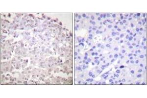 Immunohistochemistry analysis of paraffin-embedded human breast carcinoma tissue, using GADD153 Antibody. (DDIT3 antibody  (AA 91-140))