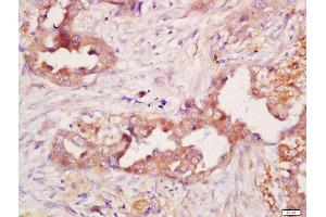 Formalin-fixed and paraffin embedded human lung carcinoma labeled with Anti-Polyclonal Antibody, Unconjugated 1:200 followed by conjugation to the secondary antibody and DAB staining (CD21 antibody  (AA 981-1092))
