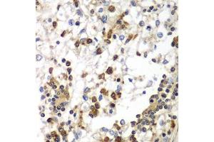 Immunohistochemistry of paraffin-embedded human kidney cancer using SND1 antibody.