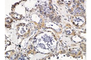 ABIN6258471 and ABIN6275673 at 1/100 staining human ovarian cancer by IHC-P. (VTI1A antibody  (Internal Region))