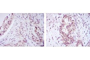 Immunohistochemical analysis of paraffin-embedded mammary cancer tissues (left) and ovarian cancer tissues (right) using NACC1 mouse mAb with DAB staining.