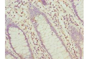 Immunohistochemistry of paraffin-embedded human colon cancer using ABIN7155961 at dilution of 1:100 (HABP2 antibody  (AA 314-560))