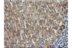 Immunohistochemical staining of paraffin-embedded Human liver tissue using anti-SOCS3 mouse monoclonal antibody. (SOCS3 antibody)
