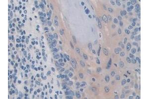 Detection of IREB2 in Human Skin cancer Tissue using Polyclonal Antibody to Iron Responsive Element Binding Protein 2 (IREB2) (IREB2 antibody  (AA 39-281))