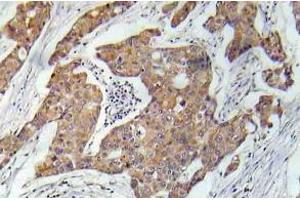 Immunohistochemistry (IHC) analyzes of VEGFR2 pAb in paraffin-embedded human prostate carcinoma tissue. (VEGFR2/CD309 antibody)