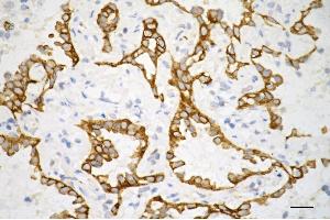 Immunohistochemistry was performed on paraffin-embedded human lung adenocarcinoma using keratin 7 antibody (ABIN7799186), 1:200).
