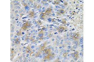 Immunohistochemistry of paraffin-embedded Human liver cancer using SERPINA1 Polyclonal Antibody at dilution of 1:100 (40x lens). (SERPINA1 antibody)