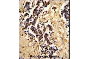 Formalin-fixed and paraffin-embedded human kidney carcinoma reacted with EHD3 Antibody , which was peroxidase-conjugated to the secondary antibody, followed by DAB staining. (EHD3 antibody  (AA 189-216))