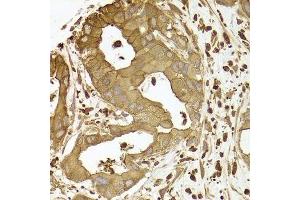 Immunohistochemistry of paraffin-embedded human liver cancer using ACTR2 antibody. (ACTR2 antibody  (AA 1-160))