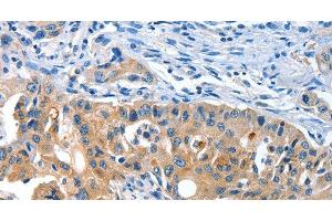 Immunohistochemistry of paraffin-embedded Human lung cancer tissue using AMHR2 Polyclonal Antibody at dilution 1:40 (AMHR2 antibody)