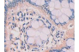 DAB staining on IHC-P; Samples: Human Colorectal cancer Tissue (ZBP1 antibody  (AA 10-167))