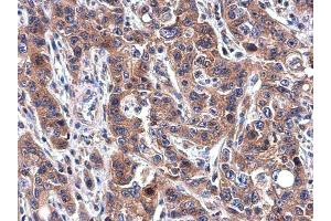 IHC-P Image Transferrin antibody [N3C3] detects Transferrin protein at cytoplasm in human esophageal carcinoma by immunohistochemical analysis.