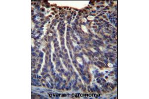HOXB3 Antibody (Center) (ABIN656507 and ABIN2845779) immunohistochemistry analysis in formalin fixed and paraffin embedded human ovarian carcinoma followed by peroxidase conjugation of the secondary antibody and DAB staining.