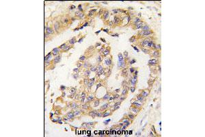 Formalin-fixed and paraffin-embedded human lung carcinoma tissue reacted with OLFM1 polyclonal antibody  , which was peroxidase-conjugated to the secondary antibody, followed by DAB staining. (Olfactomedin 1 antibody  (N-Term))