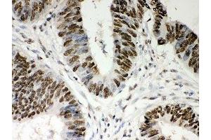 IHC-P: Nucleophosmin antibody testing of human intestine cancer tissue