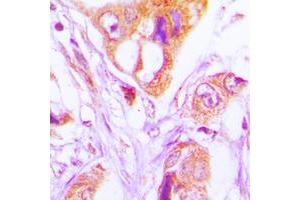 Immunohistochemical analysis of FADD staining in human lung cancer formalin fixed paraffin embedded tissue section.